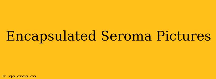 Encapsulated Seroma Pictures